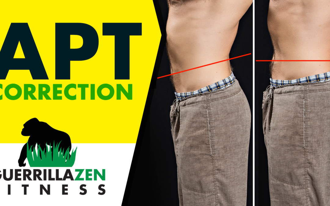 Anterior Pelvic Tilt Before and After