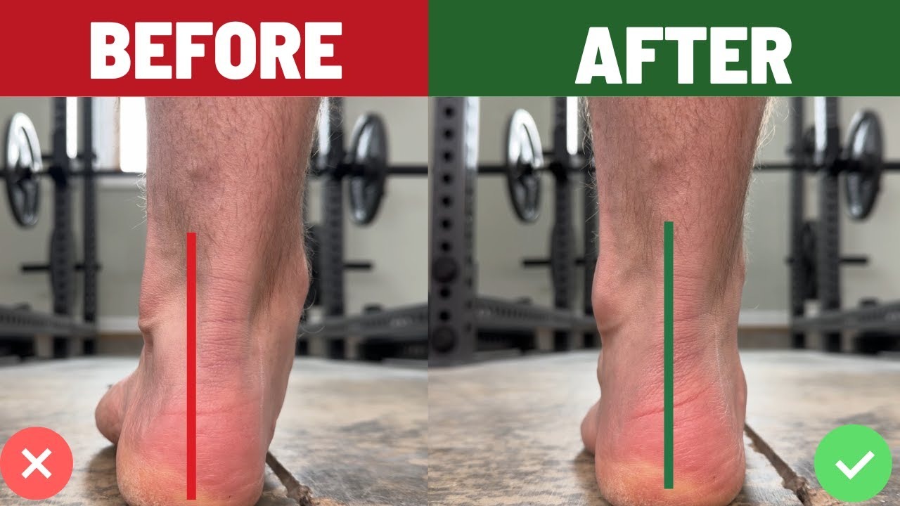 The Real Fix for Pronated Ankles (It’s NOT Just Arch Strength)